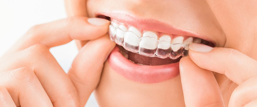 Invisalign For Crooked Teeth